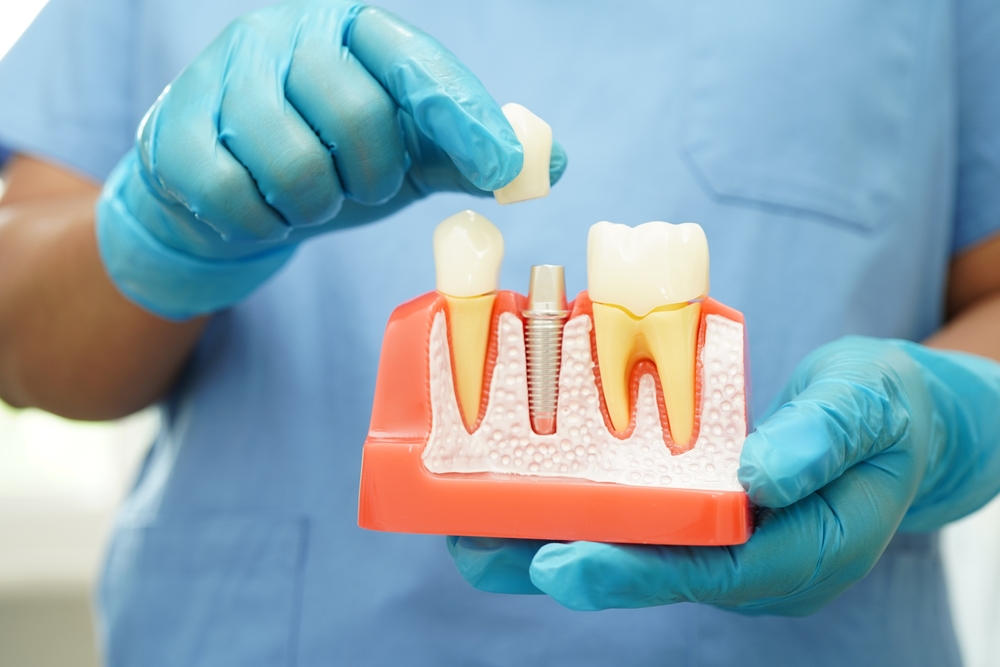 how dental implants can improve your health