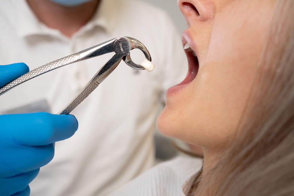 what adults should know about wisdom teeth removal